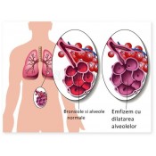 Afectiuni pulmonare grave(pleurezie, emfizem)